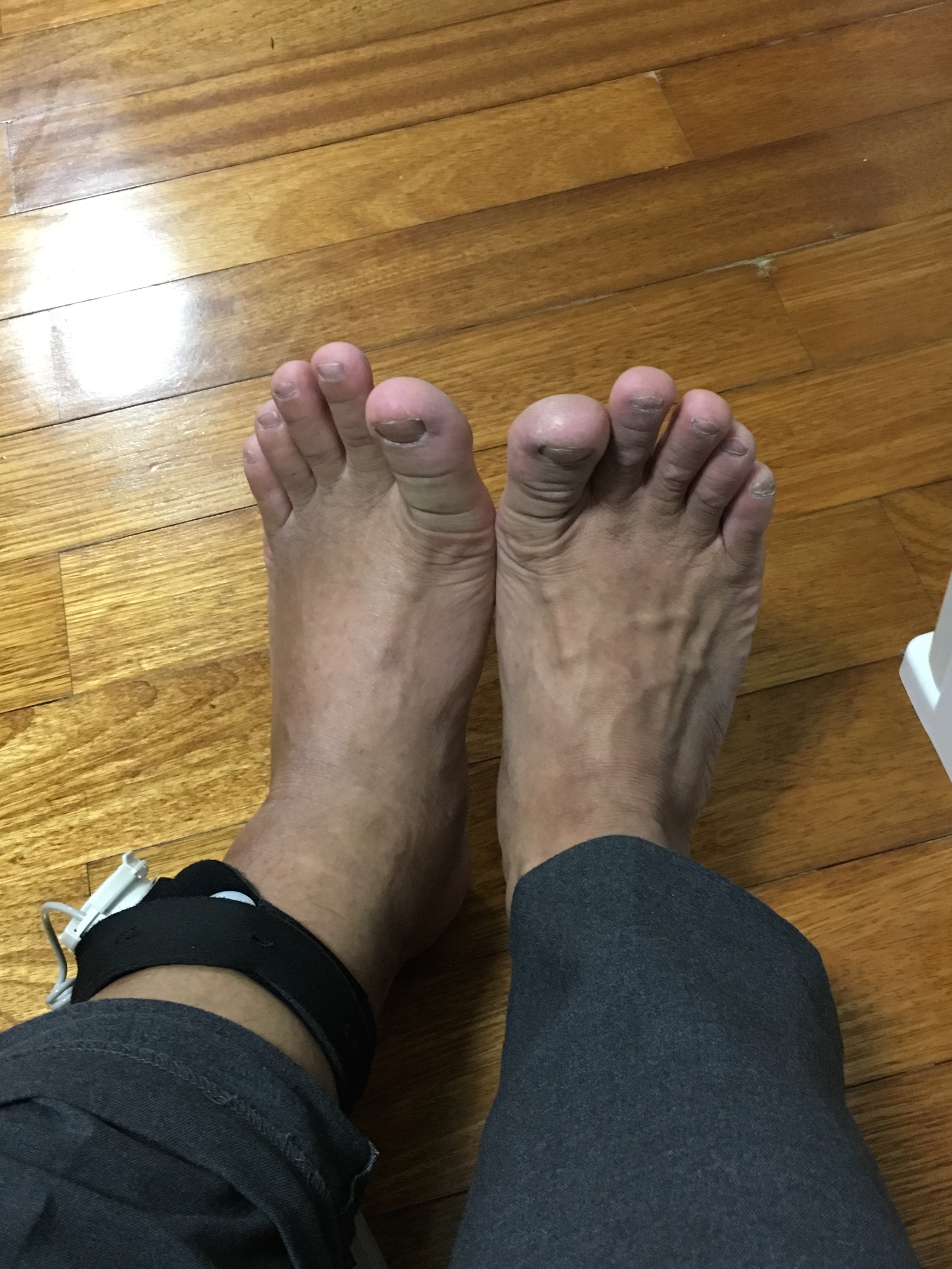 まだまだむくみもあります。