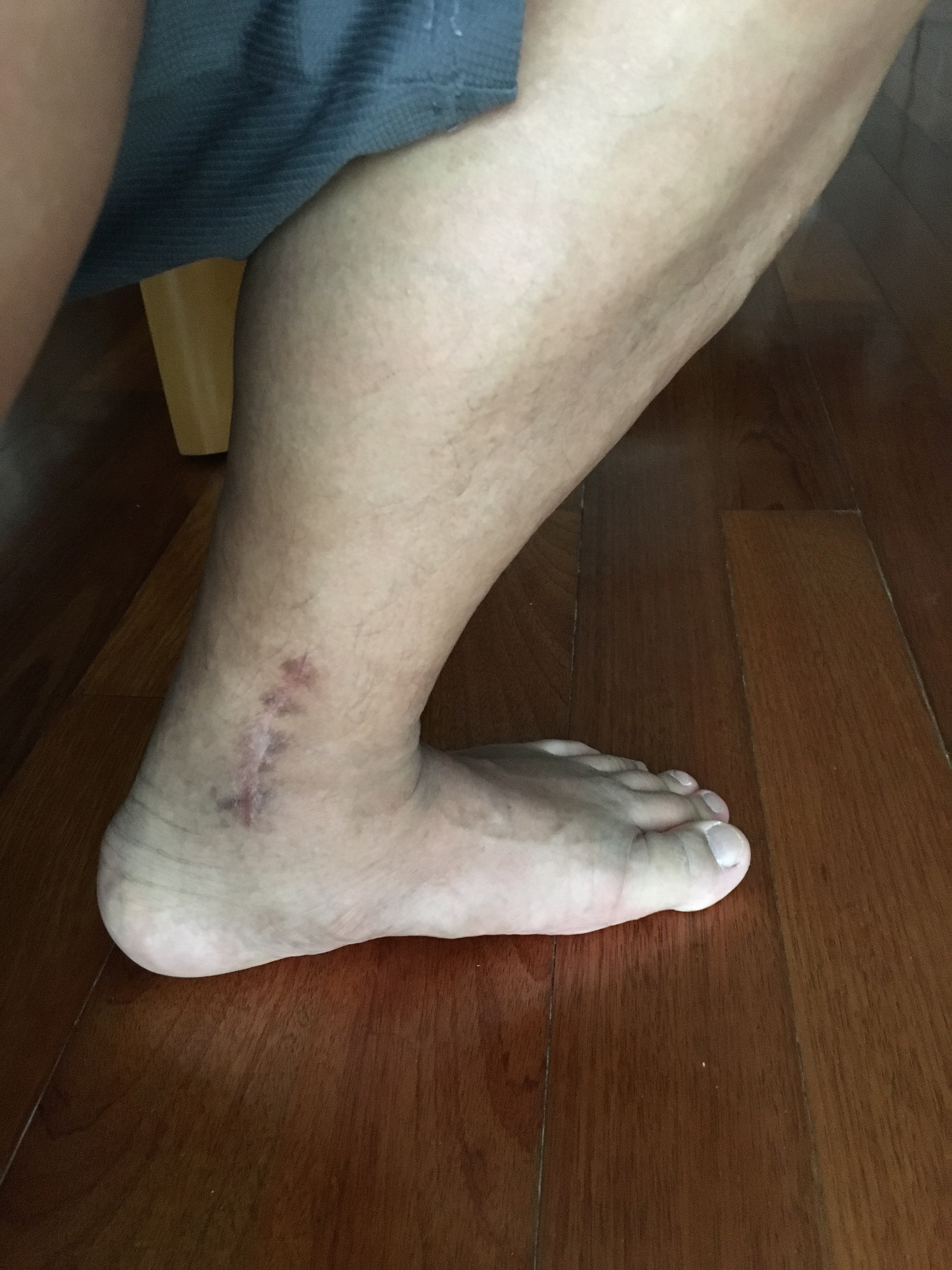 3月頃の足首の様子まだ曲がりが悪く傷跡も残る